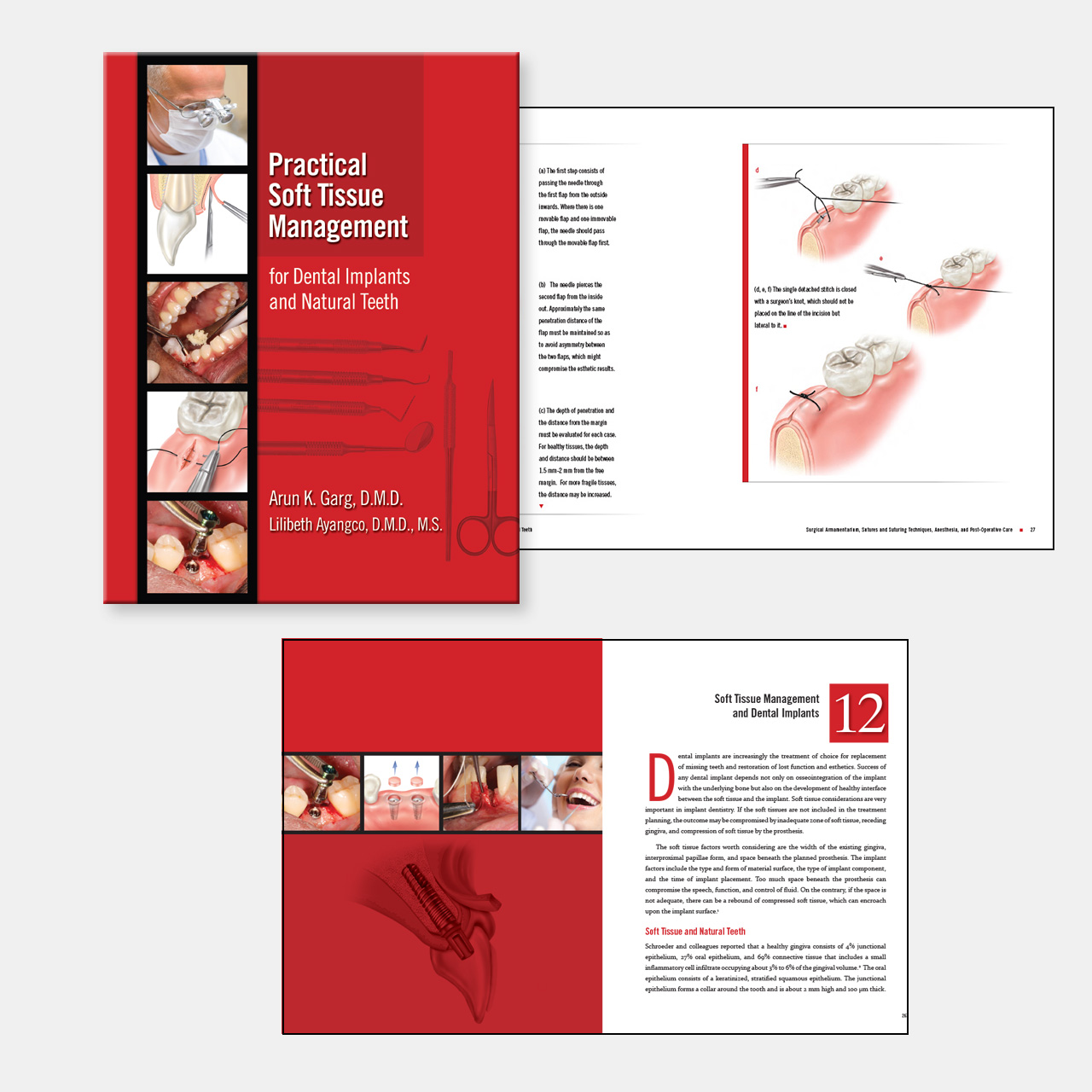 Dental Implant instruction books by Dr. Arun Garg